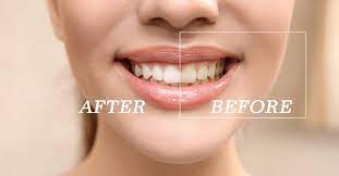 Maybe you would like to learn more about one of these? Top 5 Ways To Fix Teeth Discoloration