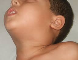In a healthy child, the bone marrow makes blood stem cells (immature cells) that become mature blood cells over time. Hodgkin Lymphoma Amboss