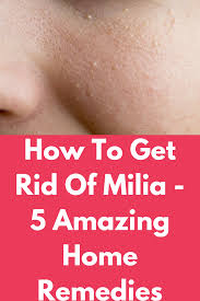 Today, i am tackling how to get rid of milia, those hard white bumps for you! How To Get Rid Of Milia 5 Amazing Home Remedies Milia Is The Keratin Filled Cysts They Are Commonly Know How To Get Rid Of Milia Get Rid Of Milia Milk Spots