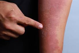Check spelling or type a new query. Safety Of Systemic Immunomodulatory Drugs In Atopic Dermatitis