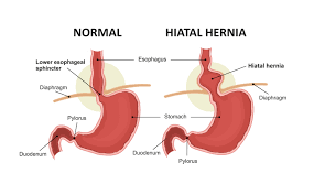 Although screenings for prostate cancer are one tool for early detecti. Hernia Narayana Health