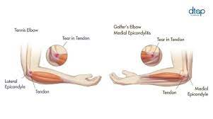 The pain might also spread. Tennis Elbow Golfer S Elbow Symptoms Treatment Dr Tan Partners