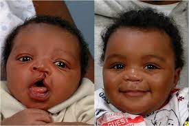 Your child may need pain medicine for the first few days after surgery. What You Need To Know About Cleft Lip And Cleft Palate Beyond Smile 247