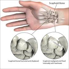 Image result for Scaphoid Bone
