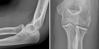 J am acad orthop surg. Anteroposterior And Lateral Radiographs Of The Injured Elbow Showing An Download Scientific Diagram