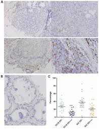 The cancer astrological sign in the zodiac. Csf1 Is Involved In Breast Cancer Progression Through Inducing Monocyte Differentiation And Homing