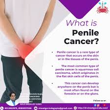 Image result for Penile Cancer
