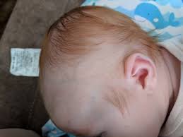 Find out why it happens and when it will start to grow back. Infant Hair Loss Babycenter