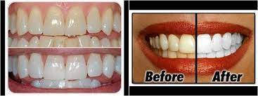 Di Adios A Los Dientes Amarillos En 2 Minutos Apunta Estos Trucos Pasta De Dientes Blanqueadora Blanqueador De Dientes Remedios