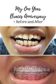 My One Year Braces Anniversary Kimberley Usman Braces My First Year Braces Transformation