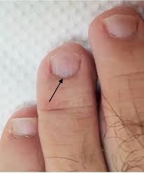 Black discoloration of the toe under the toenail is usually due to bruising from repeated trauma most often a black spot that looks like you dropped something on your toe is an old hemorrhage from trauma. Glomus Tumour Of The Fourth Toe Case Discussion And Review Of Literature Bmj Case Reports