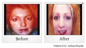 17,49,52,54,55 one of these studies demonstrated significant reduction in active acne. Cosmetic Treatments San Ramon Body Sculpting Facial Treatments Provided