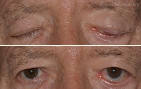 Image result for Pupillary Paralysis