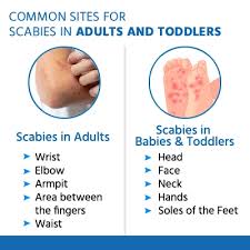 Image result for scabies symptoms