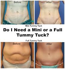 Do I Need A Mini Or Full Tummy Tuck Mini Tummy Tuck Tummy Tucks Tummy
