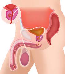 How is prostate cancer diagnosed? How Do Doctors Check For Prostate Cancer Here Are The Tests That Can Help Detect The Symptoms And Signs Early