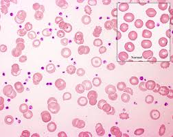 This is a trashy smear, but it does show an extremely advanced case of the microcytic/hypochromic anemia characteristic of iron deficiency. Target Cells Anemia GaleriÑ˜a Slika