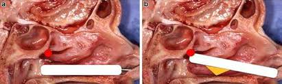 Image result for Nasal Packing