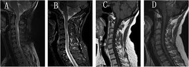 May 11, 2021 · the royal college of radiologists (rcr) leads, educates and supports doctors who are training and working in the medical specialties of clinical oncology and clinical radiology. Comparison Of Clinical Characteristics Between Neuromyelitis Optica Spectrum Disorders With And Without Spinal Cord Atrophy Bmc Neurology Full Text