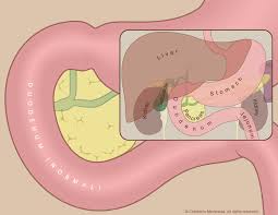 Image result for Intestinal Atresia