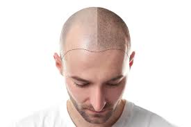Genes are not the only cause of hair loss in men under 25. Why Men Are Balding In Their 20s Vargas Face And Skin Center