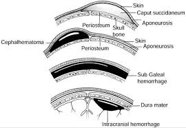 Only a minority (5.7%, 5/87) felt confident to perform a kielland's rotational delivery independently. Operative Vaginal Delivery Danforth S Obstetrics Gynecology 9th Edition