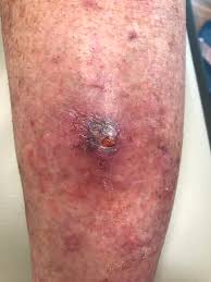 Image result for Pyoderma Gangrenosum