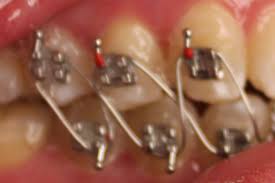 Braces For Weight Loss In South Africa Weightlosslook