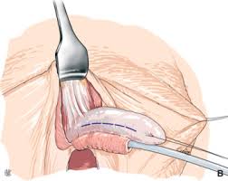 #faloplastia vs #metoidioplastia ¡muy interesante! Transformacion Genital De Mujer A Varon Faloplastia Mediante Colgajo Antebraquial Radial Y Faloplastia Mediante Colgajo Anterolateral De Muslo Sciencedirect