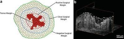 .margins (corresponding to < 1 cm margins in vivo), suggesting that a ≥ 1 cm clinical excision margin for thin melanomas reduces the risk of local recurrence cancer network (nccn) practice guidelines and reduced margins were utilized in 37 cases to preserve critical anatomical structures such as the. Intraoperative Oct In Surgical Oncology Ento Key