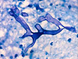 Mucormycosis is any fungal infection caused by fungi in the order mucorales.:328 generally, species in the mucor, rhizopus, absidia, and cunninghamella genera are most often implicated. What Is Mucormycosis The Deadly Fungal Infection Among Covid Patients Business Standard News