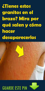 Como Quitar Los Granitos En Los Brazos Remedios Para La Salud Consejos Para La Salud Recetas Para La Salud