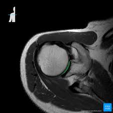 Check spelling or type a new query. Normal Shoulder Mri How To Read A Shoulder Mri Kenhub