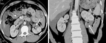 Image result for Renal Infarction