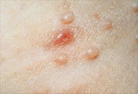 Molluscum contagiosum is mainly seen in children. Molluscum Contagiosum Picture Image On Medicinenet Com