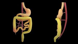 Image result for Intestinal Malrotation