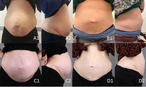 You can check on this drfiorillo.com or www.smarttummytucks.com/. Pregnancy After Abdominoplasty With Mesh Placement A Case Report Sciencedirect