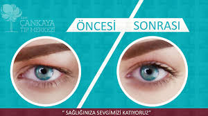 Daha Cok Ust Goz Kapagini Orten Cilt Fazlaligi Ve Yag Fitiklasmasi Ile Kendini Gosteren Bir Durum Olan Dermatosalazis Gorme Alanini Da Rinoplasti Yag Estetik
