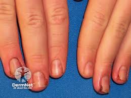 Image result for Akutní zánět nehtového lůžka