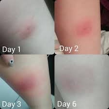 Lajmska borelioza može pogrešno da se dijagnostikuje kao multipla skleroza, reumatoidni artritis, fibromijalgija, sindrom hroničnog umora, sistemski lupus eritematozus, crohnova bolest ili neka druga autoimunska ili neurodegenerativna bolest. Naturalicious Domaci Sprej Proti Klopom Lymska Borelioza