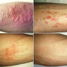 Pdf Allergic Reactions And Dermatitis To Common Bed Bug Bites A Case Report From Ahvaz Southwest Iran