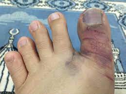 Tulang jari kaki adalah bagian tulang yang letaknya pada kaki dan terhubung pada aspek plantar. Ambrynaa S Photo Diary Kemalangan Dalam Rumah Tulang Ibu Jari Retak