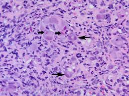 They may not always be identifiable, especially if the biopsy is taken from the center of the ulcer instead of the margins. Necrotizing Esophagitis An Overview Sciencedirect Topics