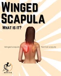 Image result for Winged Scapula