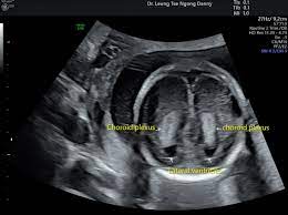 Choroid Plexus Cyst Cpc Hkog Info