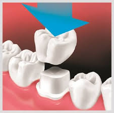 Sometimes the tooth is loose because there is a fracture. Temporary Solutions Dental Crown Dental Filling Local Family Dentist
