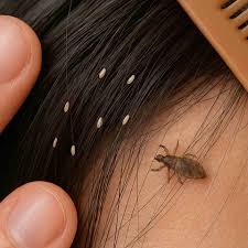 Image result for lice vs nits