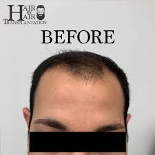 In the fue hair transplantation method, the hair follicles are taken one by one with special tip micro motors under local anesthesia and placed in hairless eyebrow transplant procedures. Hair By Hair Transplantation Photos Facebook