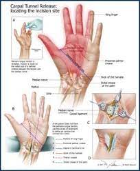 Carpal tunnel syndrome associated with pregnancy generally gets better on its own after other medical conditions. Carpal Tunnel Definition Of Release Carpal Tunnel Carpal Tunnel Carpal Tunnel Relief Carpal Tunnel Syndrome