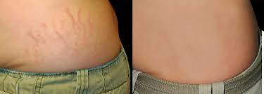 The answer to this question depends on your willingness to go through. Laser Stretch Mark Removal Experts Perfect Body Laser Aesthetics Long Island Ny